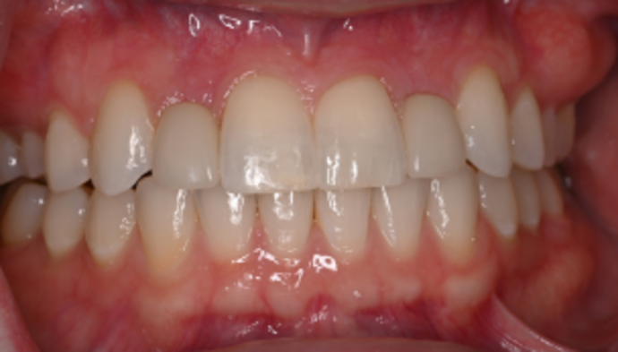 Dental Implants Case 1 - After