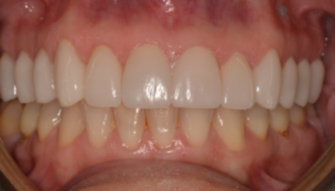 Smile Makeover Case 1 - After
