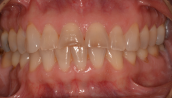 Smile Makeover Case 1 - Before