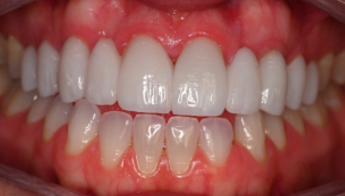 Smile Makeover Case 2 - After