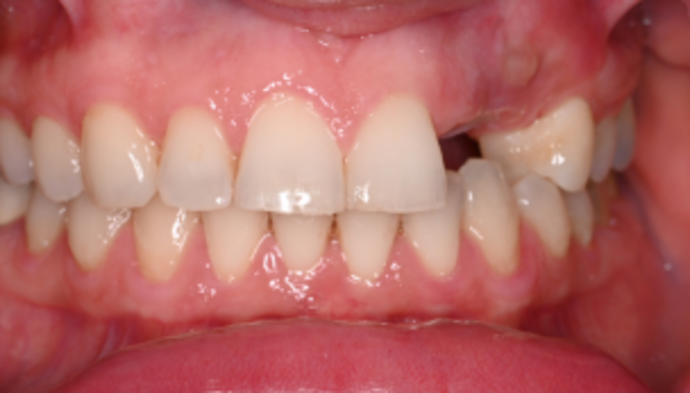 Smile Makeover Case 3 - Before