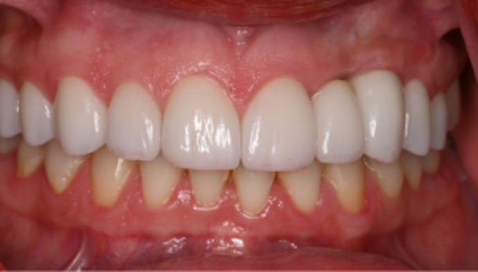 Smile Makeover Case 3 - After
