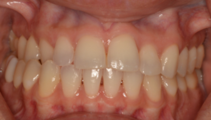 Smile Makeover Case 4 - Before