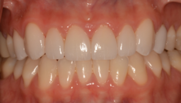 Smile Makeover Case 4 - After