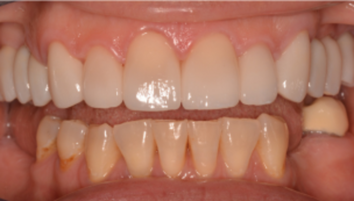 Smile Makeover Case 5 - After