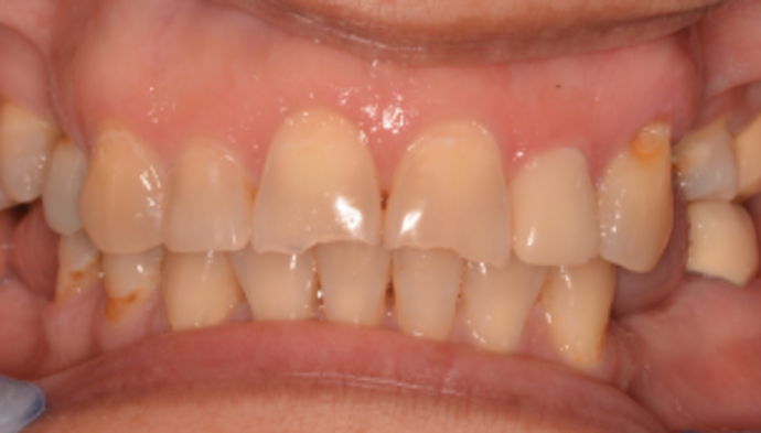 Smile Makeover Case 5 - Before