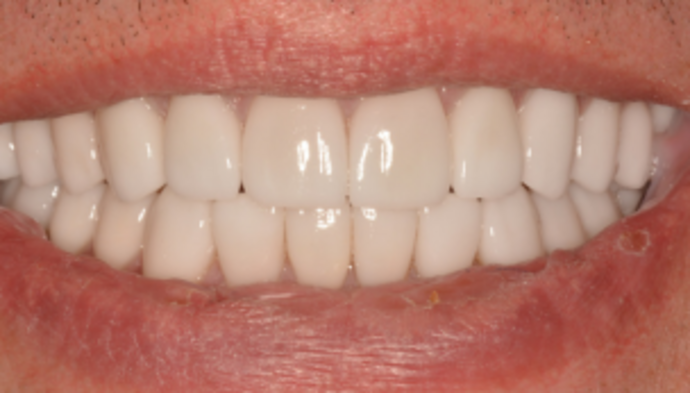 Full Mouth Reconstruction Case 4 - After