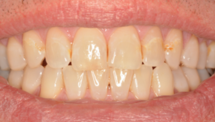 Full Mouth Reconstruction Case 4 - Before