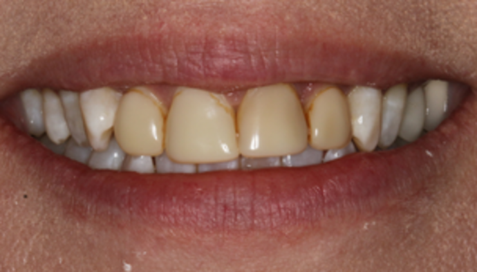 Smile Makeover Case 6 - Before
