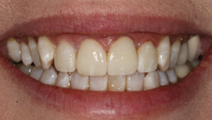 Smile Makeover Case 6 - After