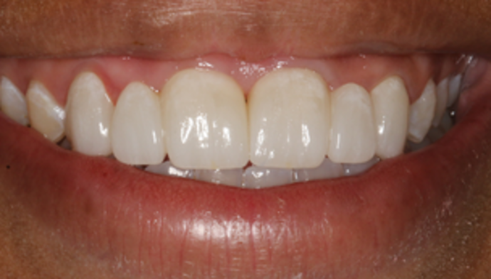 Smile Makeover Case 7 - After
