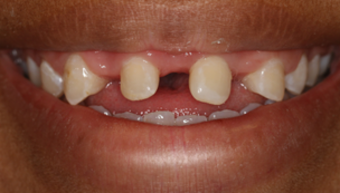 Smile Makeover Case 7 - Before