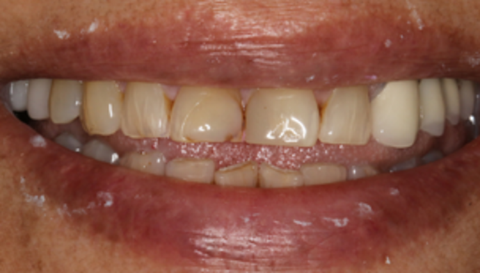 Smile Makeover Case 8 - Before