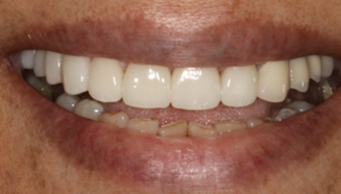 Smile Makeover Case 8 - After