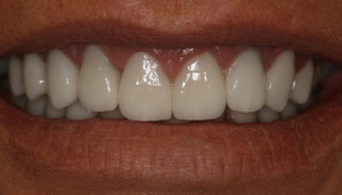 Smile Makeover Case 9 - After