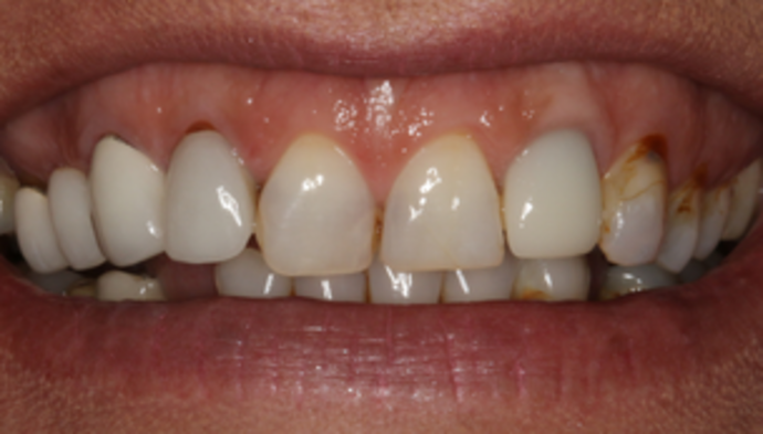 Smile Makeover Case 9 - Before