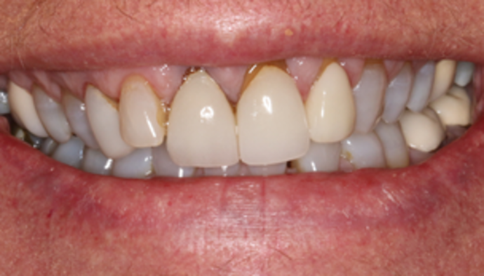 Smile Makeover Case 10 - Before