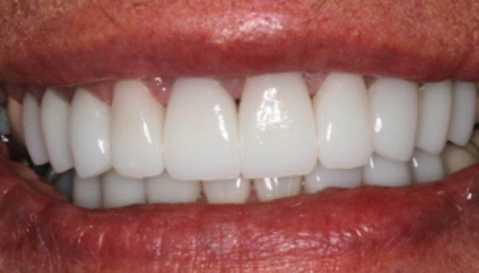 Smile Makeover Case 10 - After