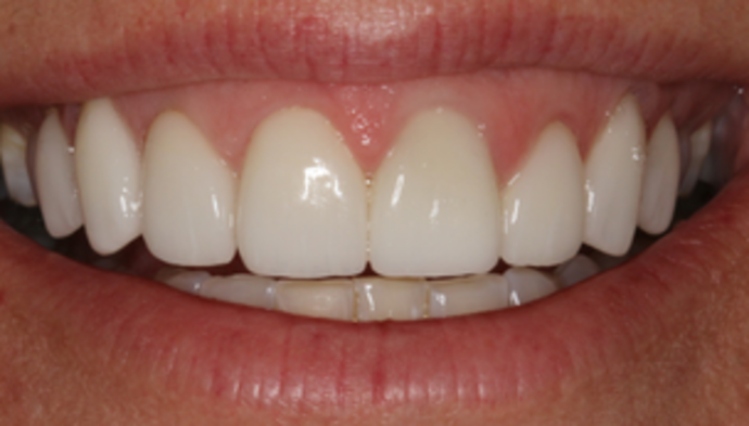 Smile Makeover Case 11 - After