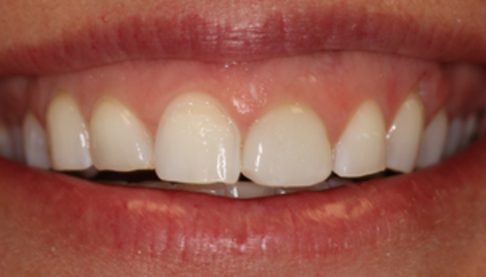 Smile Makeover Case 11 - Before