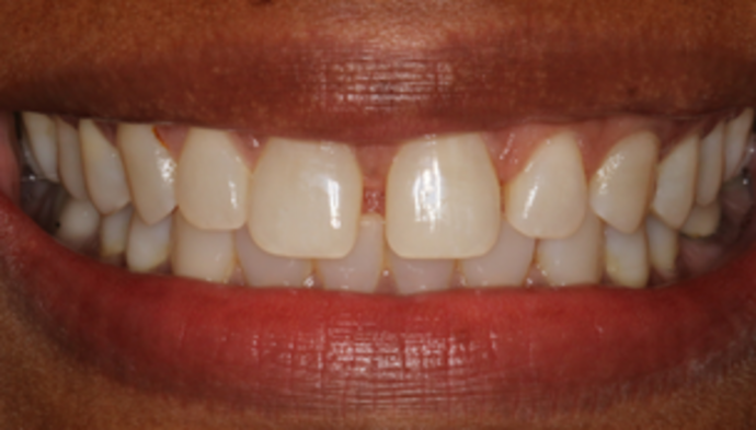 Smile Makeover Case 12 - Before