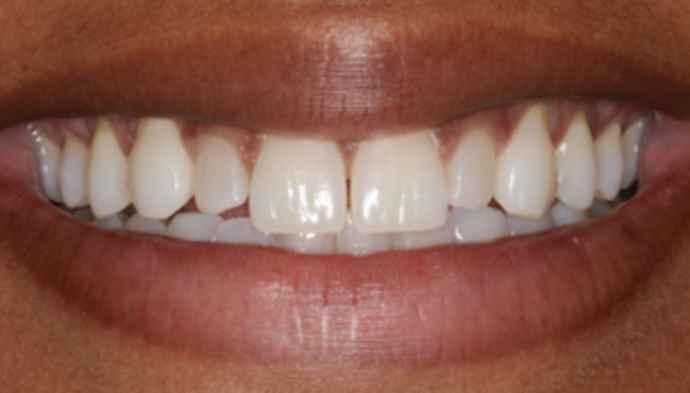 Smile Makeover Case 12 - After
