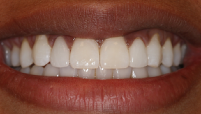 Smile Makeover Case 13 - After