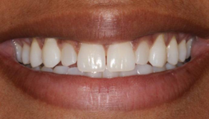 Smile Makeover Case 13 - Before