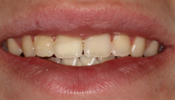 Smile Makeover Case 14 - Before