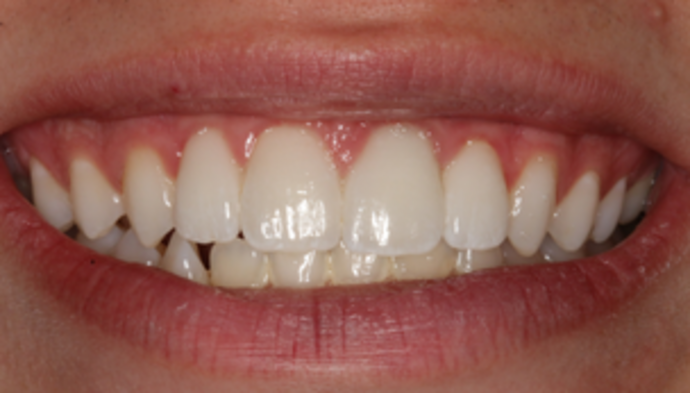 Smile Makeover Case 14 - After