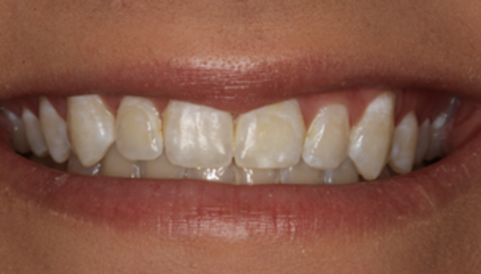Smile Makeover Case 15 - Before