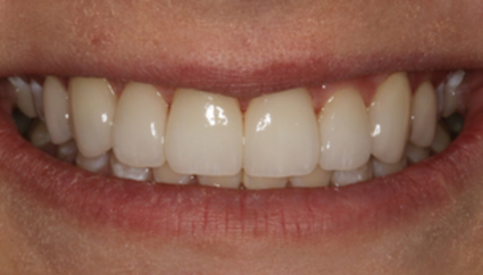 Smile Makeover Case 15 - After