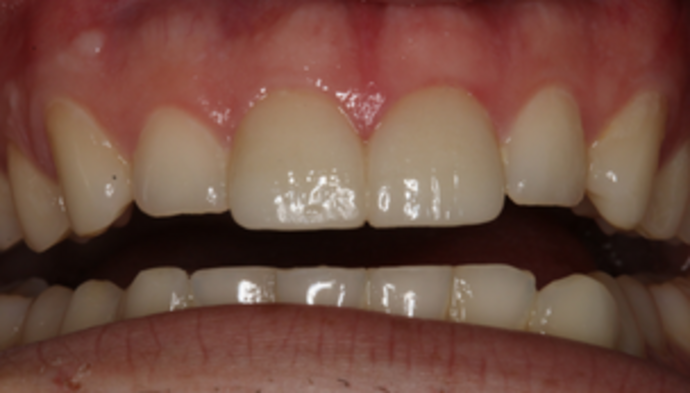 Smile Makeover Case 16 - After