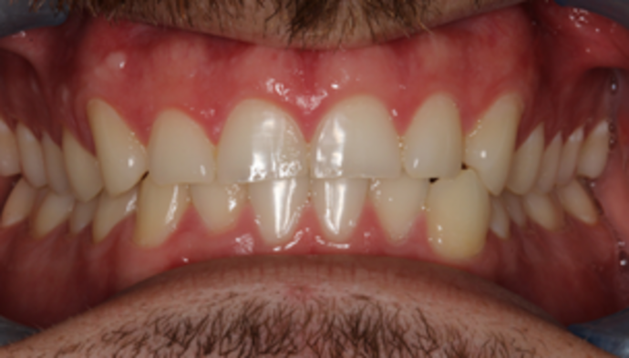 Smile Makeover Case 16 - Before