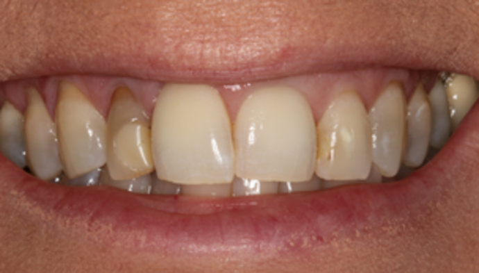 Smile Makeover Case 17 - Before