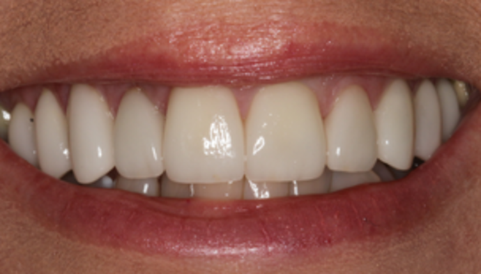 Smile Makeover Case 17 - After
