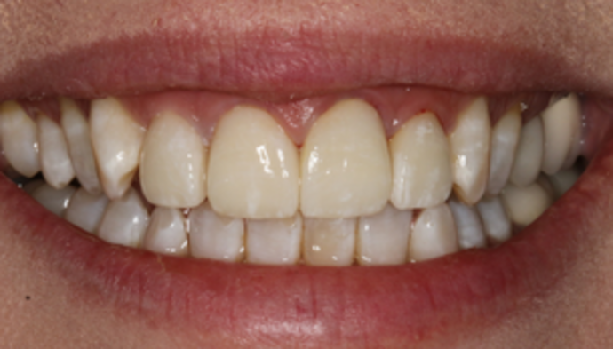 Smile Makeover Case 18 - After