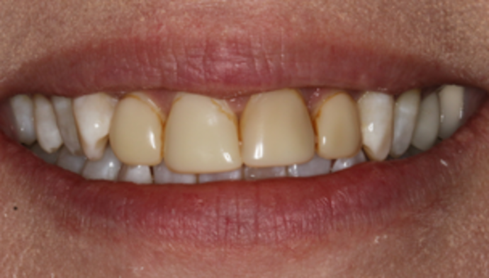 Smile Makeover Case 18 - Before