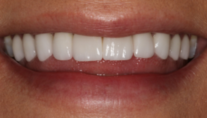 Smile Makeover Case 19 - After