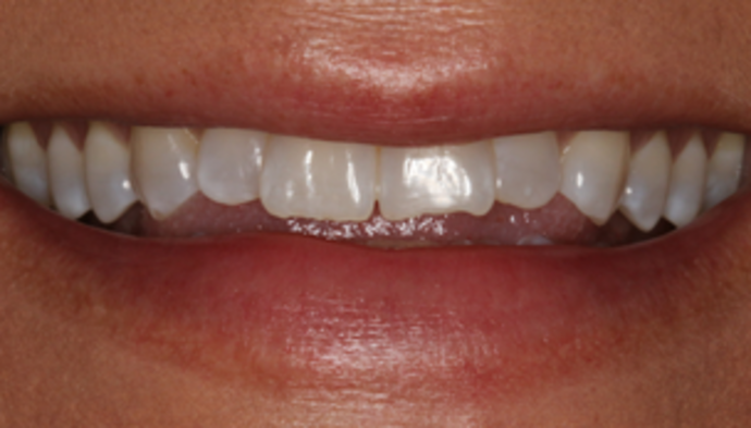 Smile Makeover Case 19 - Before