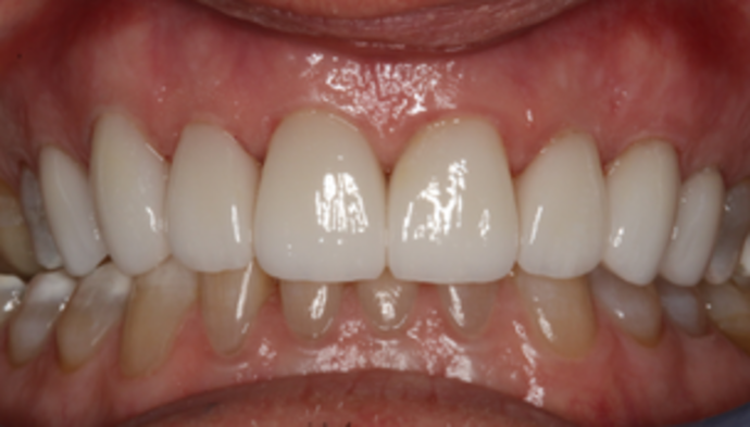 Smile Makeover Case 20 - After