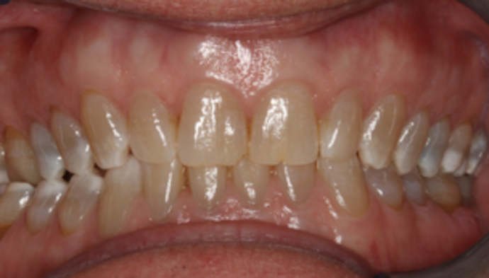 Smile Makeover Case 20 - Before