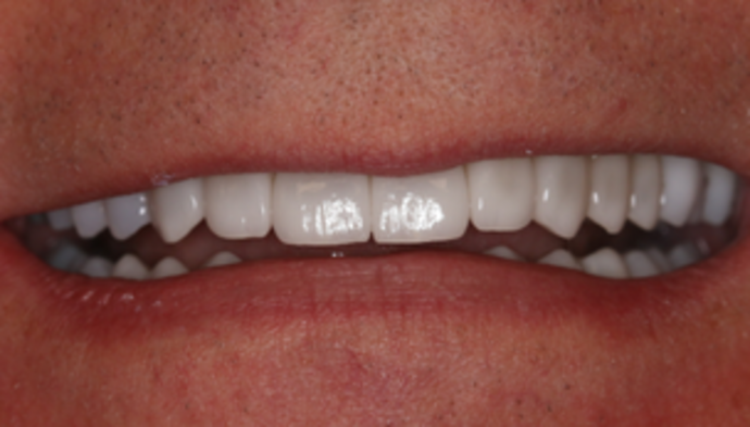 Smile Makeover Case 21 - After