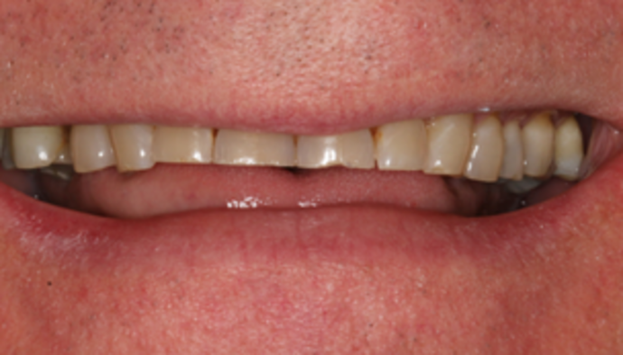 Smile Makeover Case 21 - Before