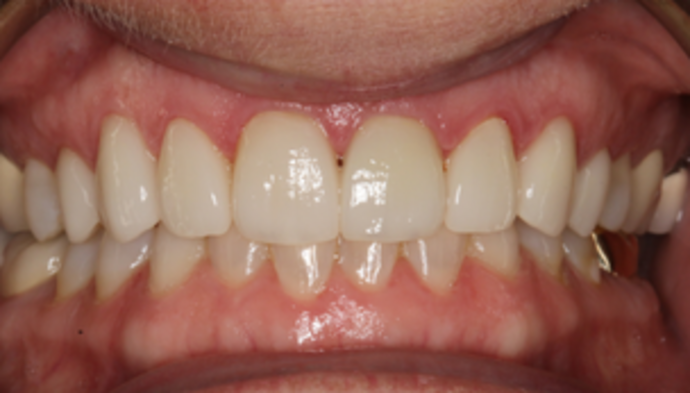 Smile Makeover Case 22 - After