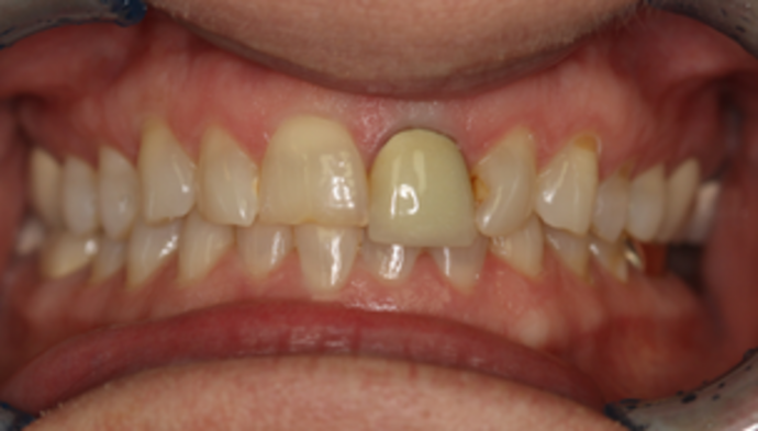 Smile Makeover Case 22 - Before