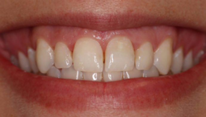 Smile Makeover Case 23 - Before