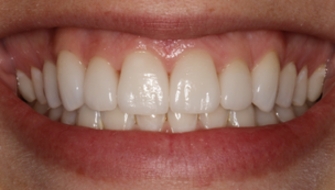 Smile Makeover Case 23 - After