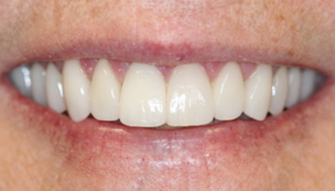 Smile Makeover Case 24 - After