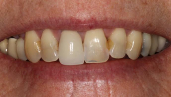 Smile Makeover Case 24 - Before